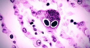 cmv citomegalovirus neumocitos