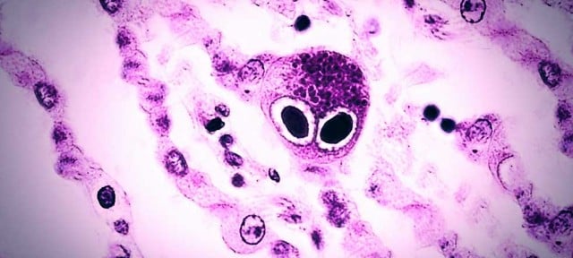 cmv citomegalovirus neumocitos