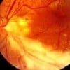 citomegalovirus-ojo-fondo