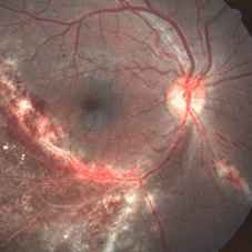 foto citomegalovirus retina