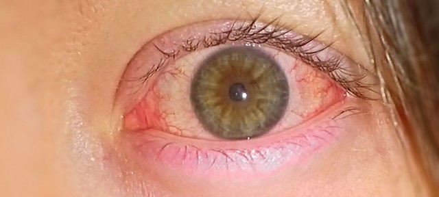 conjuntivitis-foto